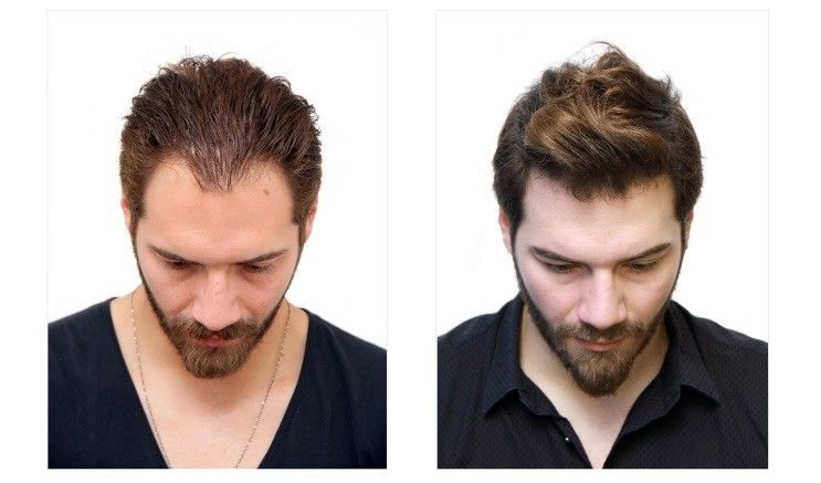 مراحل رشد مو بعد از کاشت مو چگونه است؟